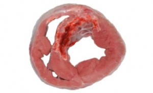 Section transversale d'un cœur de patient ayant subi un infarctus. En rouge foncé, le dommage causé au ventricule gauche.